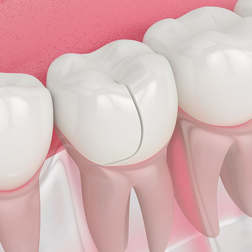 a cracked tooth