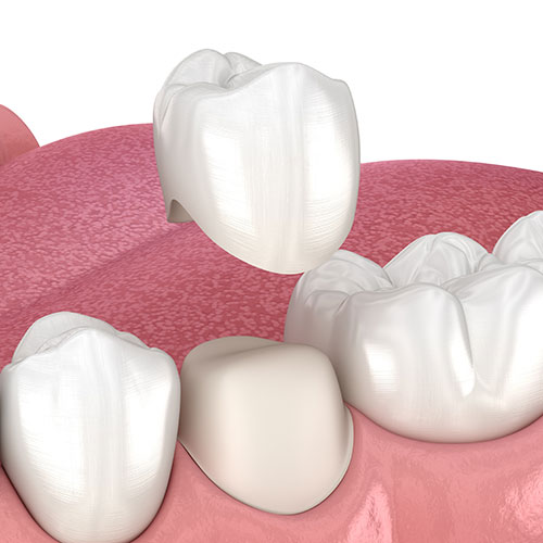 a dental crown hover over the tooth where it will be placed