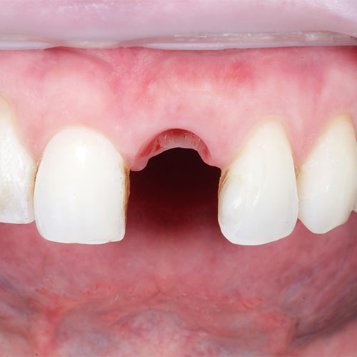 close up of a gumline with a missing tooth